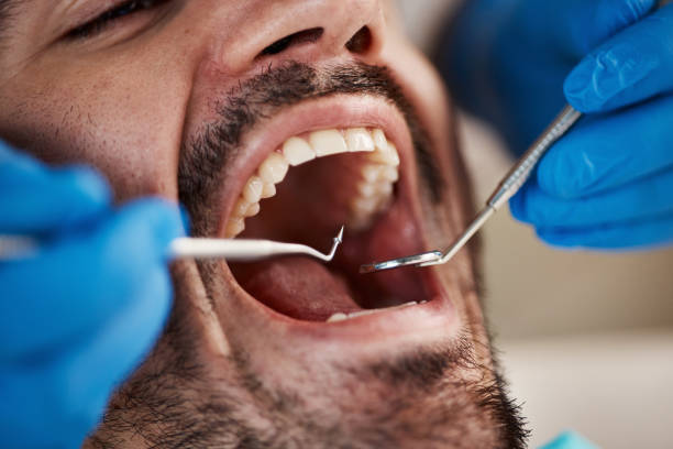 Best Emergency Wisdom Teeth Removal in Clarkesville, GA