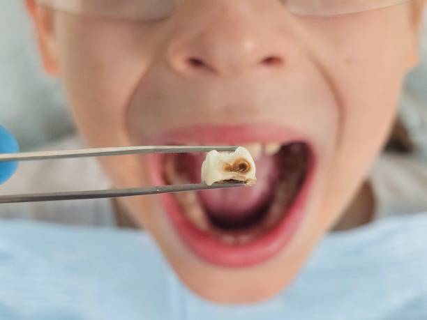 Best Emergency Treatment for Dental Infections or Abscesses in Clarkesville, GA